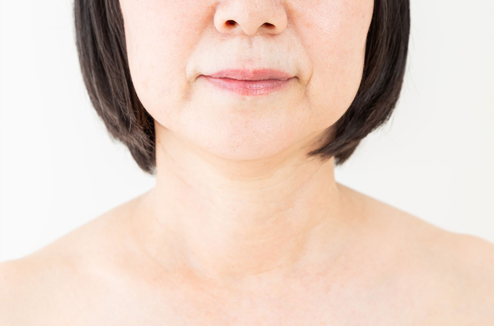 糸リフトイメージ