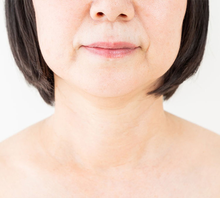 糸リフトイメージ