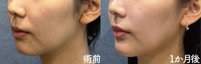 症例写真（20代女性／アゴヒアルロン酸）