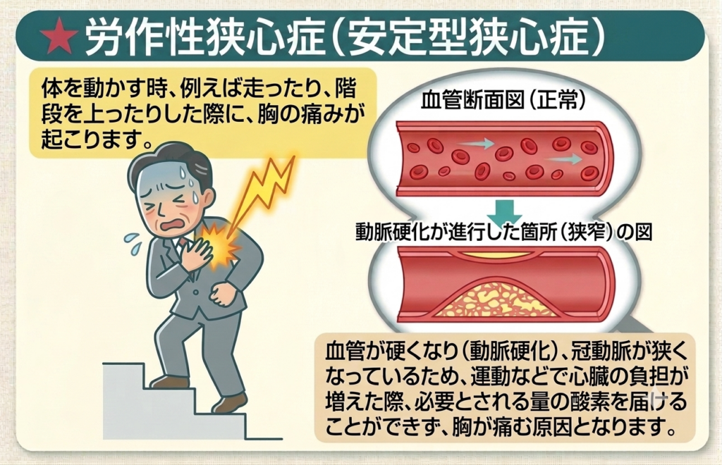 1. 「階段は平気なのに、なぜ？」安静時やストレス時に襲う胸の違和感